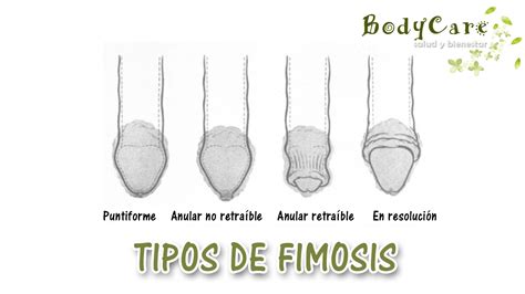 Los 5 Tipos de Fimosis